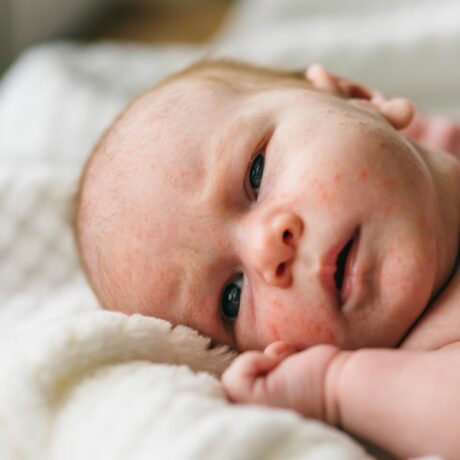 Bebeluș, care stă pe-o parte, în pat, cu o mână la obraz, și are acnee pe față, frunte și bărbie