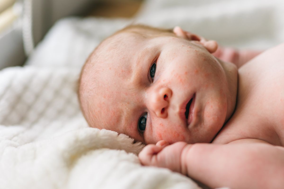 Bebeluș, care stă pe-o parte, în pat, cu o mână la obraz, și are acnee pe față, frunte și bărbie