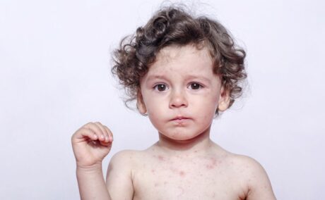 Băiețel dezbrăcat în partea de sus, cu bubițe pe față și corp, cu o mână ridicată, ilustrând bolile copilăriei