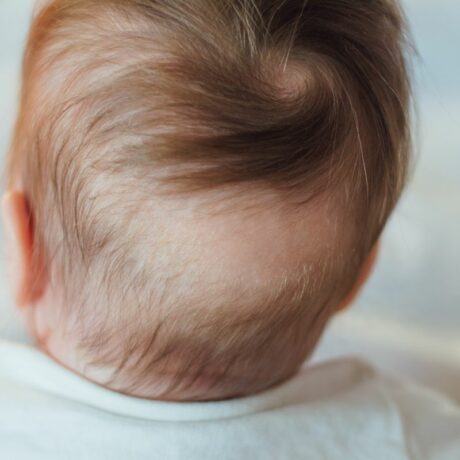 Bebeluș care stă cu spatele și se vede capul care are locuri cu păr căzut