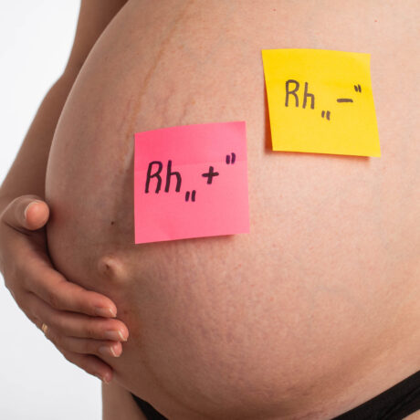 O burtică de gravidă pe care sunt lipite două sticky notes, de culoare roz și galben, pe care sunt scrise factorul Rh negativ și pozitiv