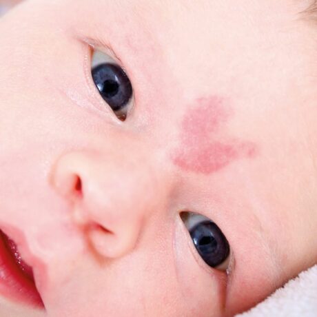 Față de bebeluș, care are Nevus simplex între sprâncene