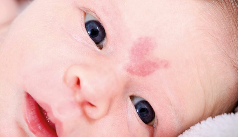 Față de bebeluș, care are Nevus simplex între sprâncene