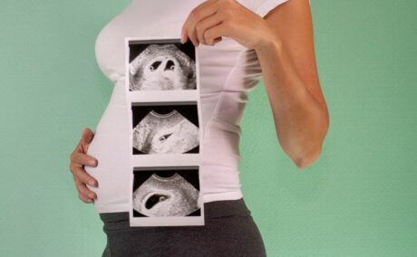 Femeie însărcinată cu gemeni, îmbrăcată cu tricou alb și colanți gri, care are o mână pe burtă și în cealaltă ține o ecografie cu cei doisaci gestaționali, iar în spate este un perete verde, ilustrând sindromul geamănului dispărut