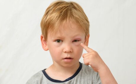 Băiețel, îmbrăcat cu tricou gri, care arată cu degetul spre unul dintre ochi, care este umflat, ilustrând anafilaxia la bebeluși și copii