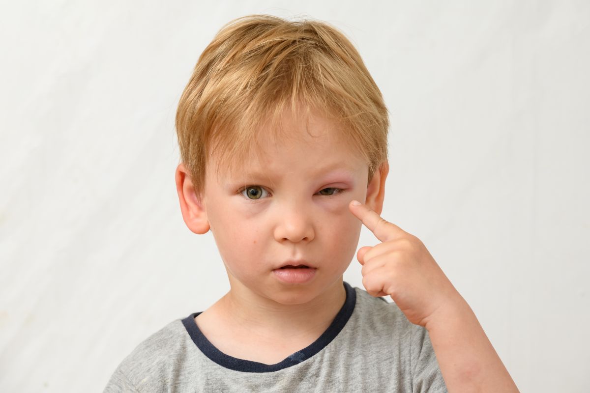 Băiețel, îmbrăcat cu tricou gri, care arată cu degetul spre unul dintre ochi, care este umflat, ilustrând anafilaxia la bebeluși și copii