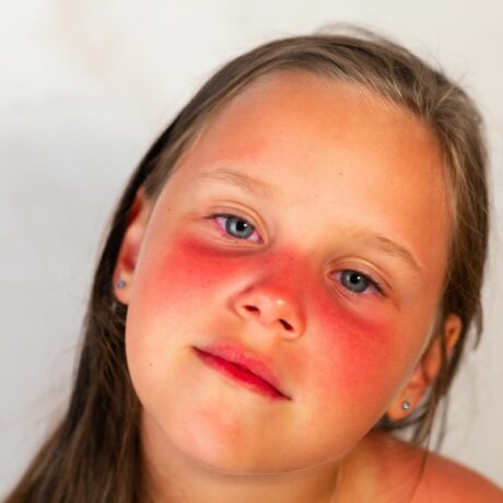 Arsurile solare la copii. Cum pot fi tratate cu blândețe