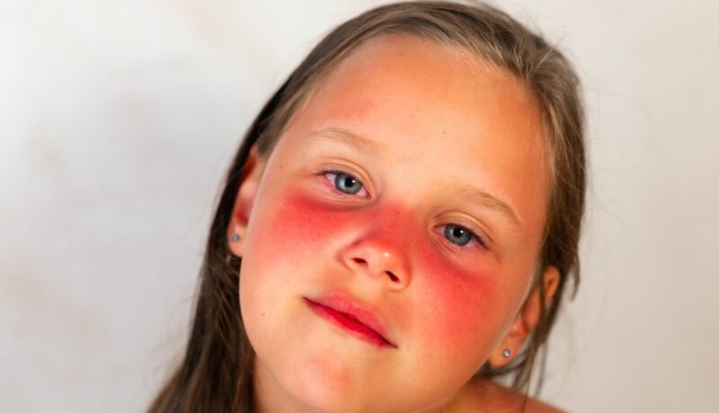 Fetiță blondă cu ochi albaștri, care prezintă arsuri solare pe obraji și frunte, ilustrând arsurile silare la copii