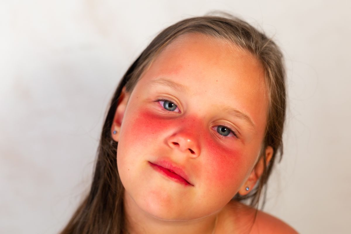 Fetiță blondă cu ochi albaștri, care prezintă arsuri solare pe obraji și frunte, ilustrând arsurile silare la copii