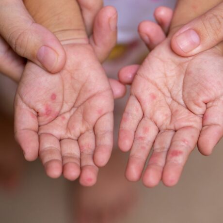 Palme de copil, ținute de mâinile mamei, care arată că acesta are boala mână-gură-picior