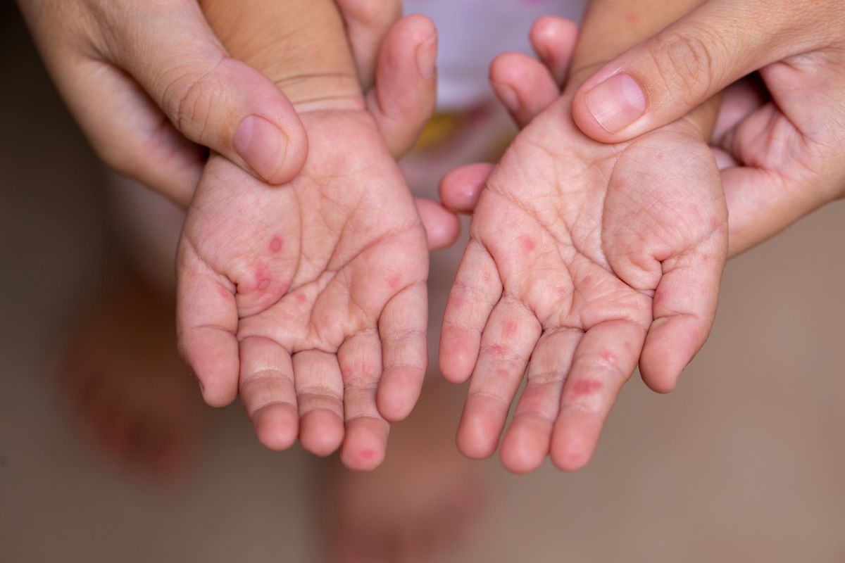 Palme de copil, ținute de mâinile mamei, care arată că acesta are boala mână-gură-picior