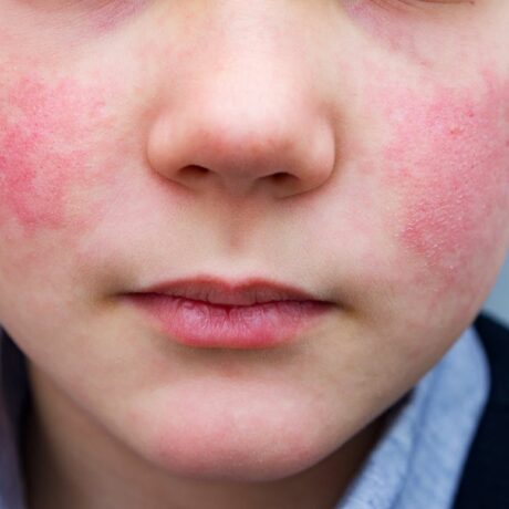 Băiat care stă cu fața și are obrajii roșii din cauza faptului că a contactat eritemul infecțios