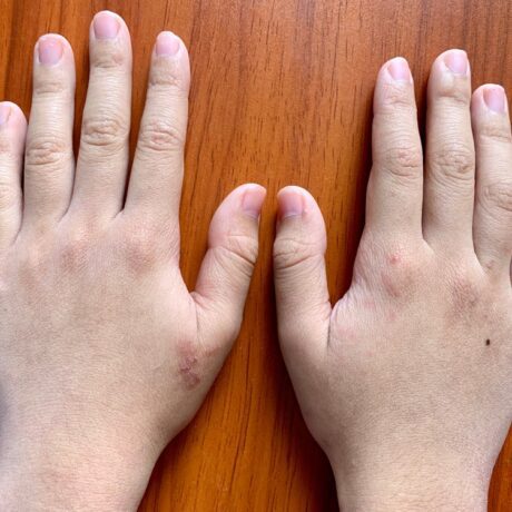 Mâinile unui copil care se confruntă cu cianoză