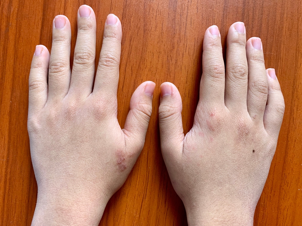 Mâinile unui copil care se confruntă cu cianoză