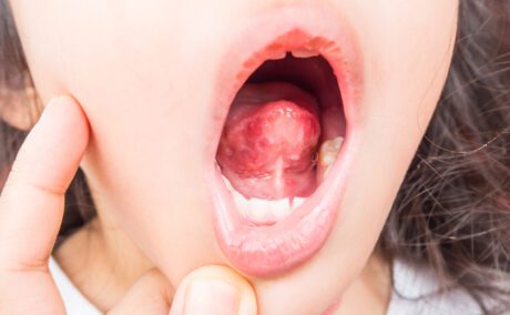 O fetiță cu gura deschisă, care are herpangină