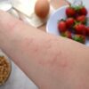 Cum se manifestă alergia la căpșuni în cazul copiilor: la ce să fii atentă