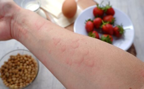 Un copil care are alergie la căpșuni