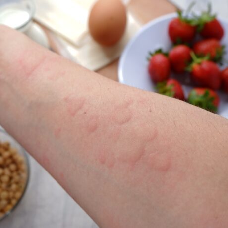 Un copil care are alergie la căpșuni