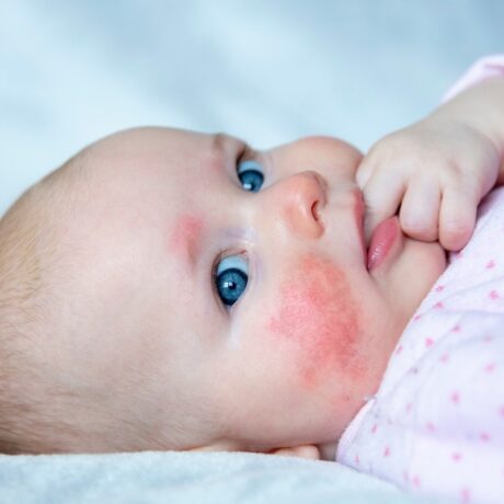 Bebeluș stă pe pat cu degetul în gură, iar pe față are dermatită