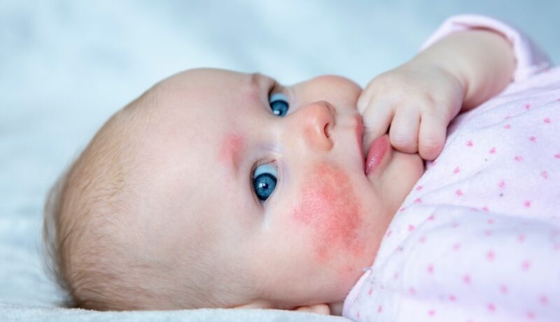 Bebeluș stă pe pat cu degetul în gură, iar pe față are dermatită