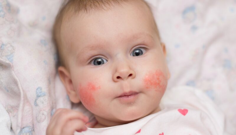 Erupții pe fața bebelușului: ce le poate provoca