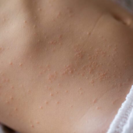 Roseola Infantum: cauze, simptome și tratament